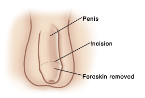 Adult Circumcision Saint Luke S Health System