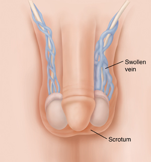 Sex After Varicocele Treatment