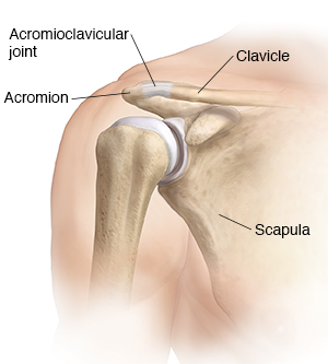 Injured your AC Joint?  Auckland Shoulder Clinic