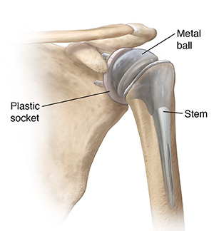 Total Shoulder Replacement Surgery | Saint Luke's Health System