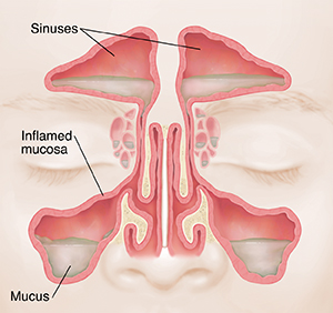 Sinus infection outlet bacterial