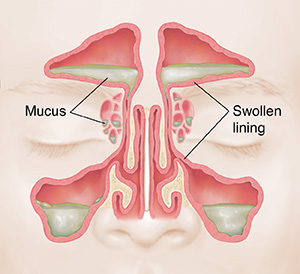 Vue de face des sinus montrant une paroi rouge et gonflée et du mucus.