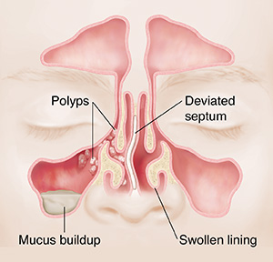 Front view of sinuses with polyps, mucus buildup, deviated septum and swollen lining.