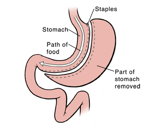 Procedure - Sleeve gastrectomy