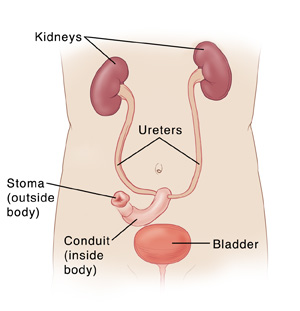 Incontinent Urinary Diversion