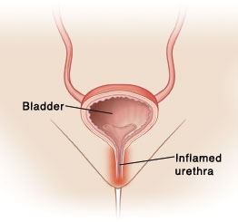 Front view of woman's pelvis. Cross section of bladder is visible in lower part of pelvis with urethra going from bladder to the outside. Urethra is inflamed.