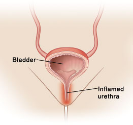 Why & How infection occurs in female urethra 