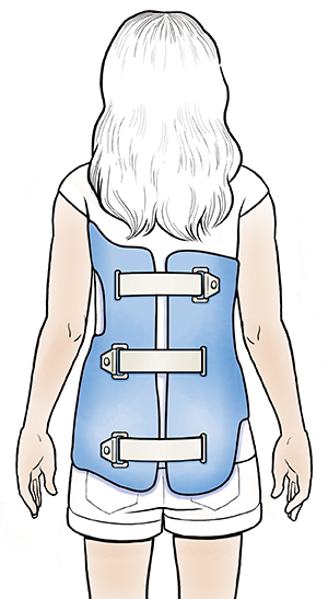 Your Scoliosis Brace | Saint Luke's Health System