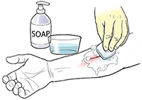 Before You Bandage: How to Properly Clean a Wound