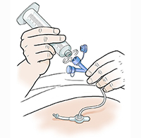 Gastrostomy Feeding Tube Care Flushing Saint Luke S Health System