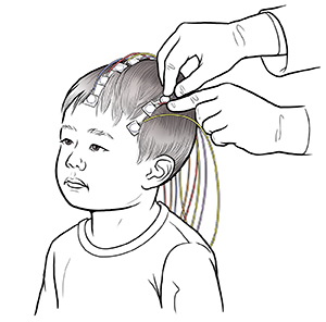 Electroencephalogram (EEG)