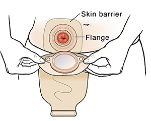 How to Change an Ostomy Bag for Nurses