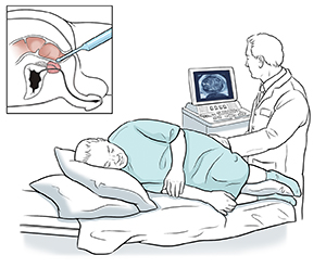 prostate ultrasound durere dureroasă în abdomenul inferior prostatita