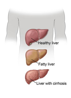 Fatty Liver Disease