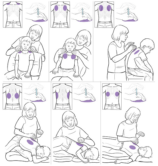 Drainage postural Postural Drainage