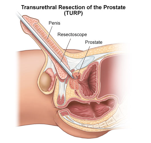 Transurethral incision of the prostate (TUIP)