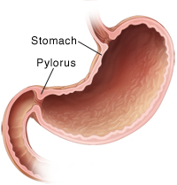 When Your Child Has Infantile Hypertrophic Pyloric Stenosis | Saint ...