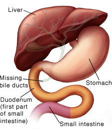 Treatment For Your Child S Biliary Atresia Kasai Procedure Saint Luke S Health System