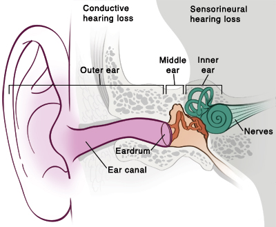 Ruptured Eardrum  Saint Luke's Health System