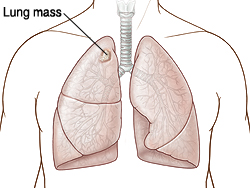 Vista frontal del tórax que muestra pulmones con masa en el pulmón derecho.