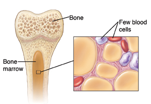 Anemia aplastic Approach to