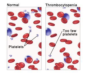 What causes a low platelet count (Thrombocytopenia)?