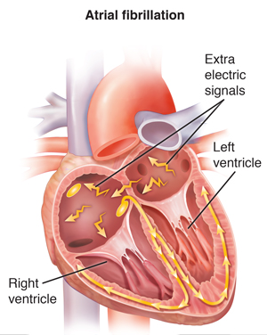 Cross section of heart showing atrial fibrillation.