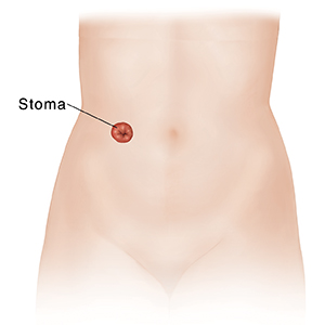 What Is a Urostomy?  Saint Luke's Health System