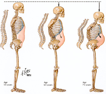 Osteoporosis in Men with Cancer | Saint Luke's Health System