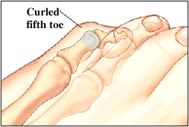Foot Surgery: Curled Fifth Toe | Saint Luke's Health System
