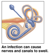 Ear canal showing how infection can cause nerves and canals to swell.