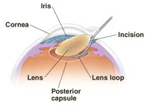 Cataract Treatment: Removing the Cloudy Lens | Saint Luke's Health System