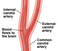 Small arteries, big trouble
