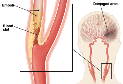 Blood clot blocking carotid artery and emboli breaking off clot. Inset shows damage to brain.