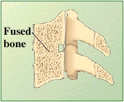 Neck Vertebrae Fused Together : Klippel-Feil syndrome: Symptoms and ...