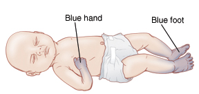 Baby with blue hands and feet.