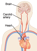 Medical illustration of brain, carotid artery, and heart