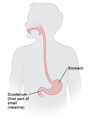 When Your Child Has A Gastric Or Duodenal Ulcer 