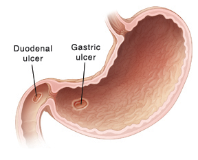 When Your Child Has a Gastric or Duodenal Ulcer | Saint Luke's Health ...