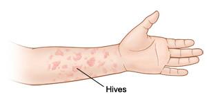 When Your Child Has Hives Urticaria Or Angioedema Saint Luke S Health System
