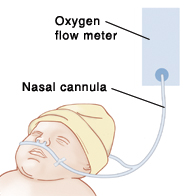 아기의 이미지의 머리와 코 정's head, with nasal cannula