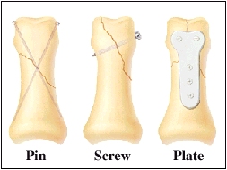 Treating Hand Fractures Saint Luke S Health System