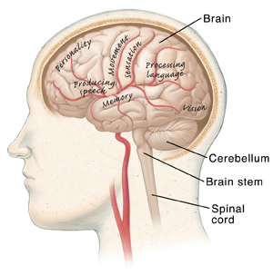 How a Stroke In The Right brain Affects The Body & How to Recover - Saebo