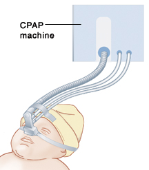 의 이미지 CPAP 장치를 통해 아기의 코's nose