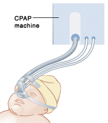 beeld van het CPAP-apparaat over de neus van de baby's nose