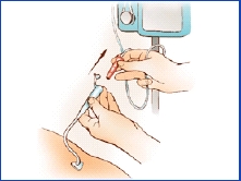 Gastrostomy Feeding Tube Care Flushing Saint Luke S Health System