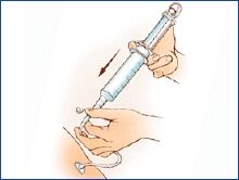 Gastrostomy Feeding Tube Care: Flushing | Saint Luke's Health System