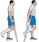 Discharge Instructions: Using Crutches (Non-Weight-Bearing) | Saint ...