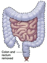 Having Bowel Surgery: Ileoanal Pouch | Saint Luke's Health System