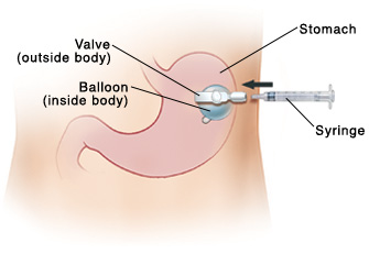 Your Child S Gastrostomy Tube Checking The Balloon Saint Luke S Health System